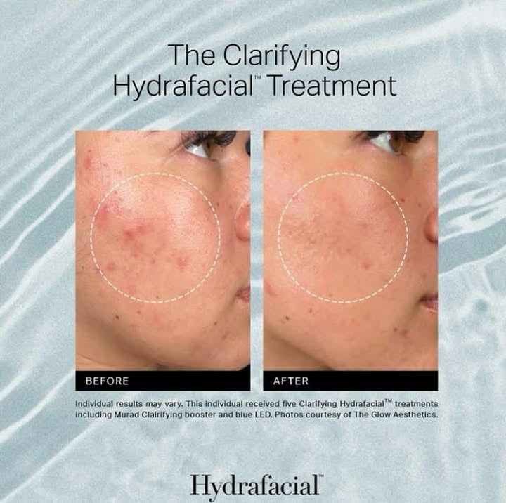 Cure de soins - Hydrafacial Clarifiant