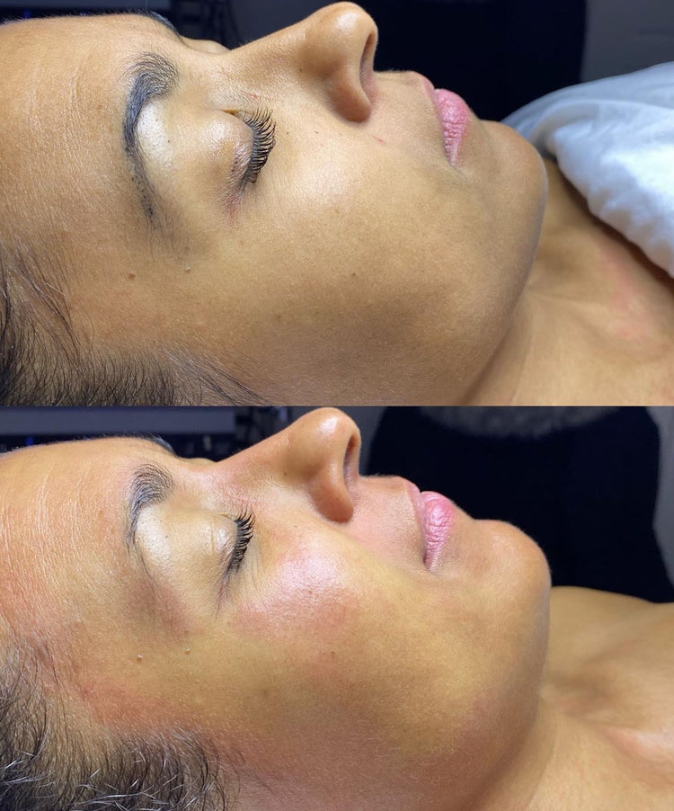 Cure de soins - Hydrafacial Deluxe