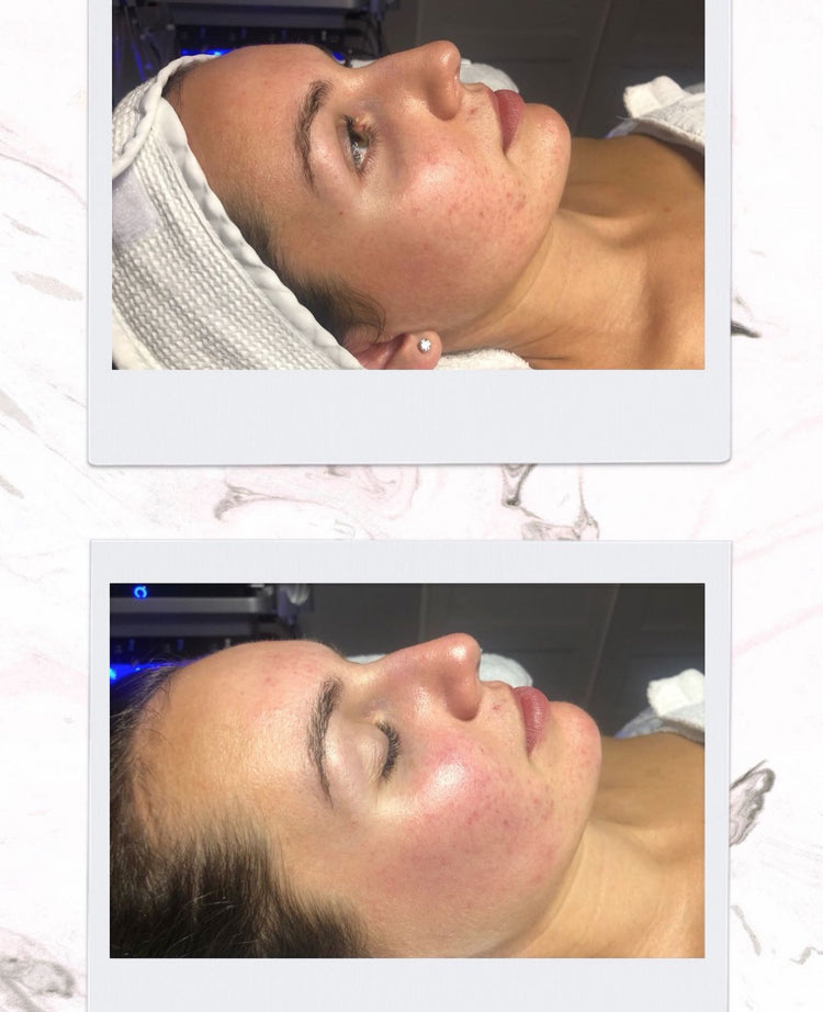 Cure de soins - Hydrafacial Deluxe