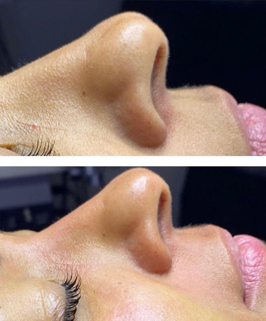 Cure de soins - Hydrafacial Deluxe