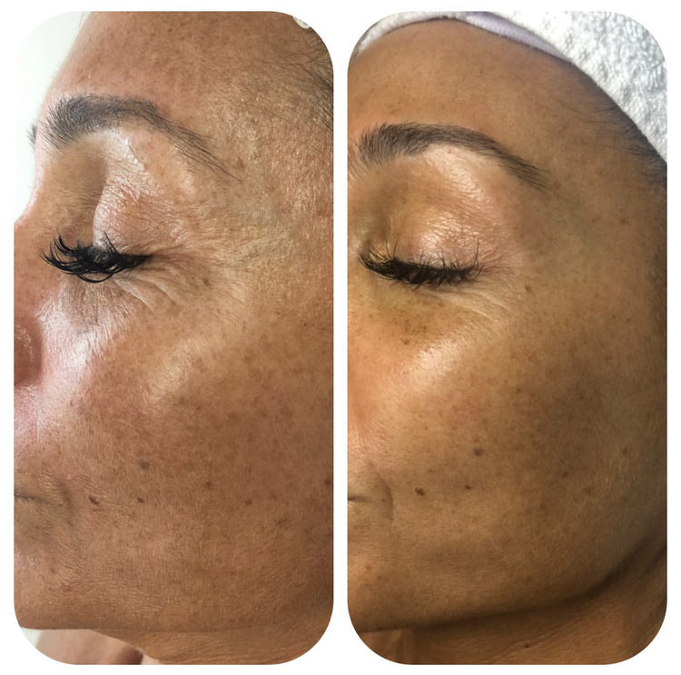 Cure de soins - Microneedling