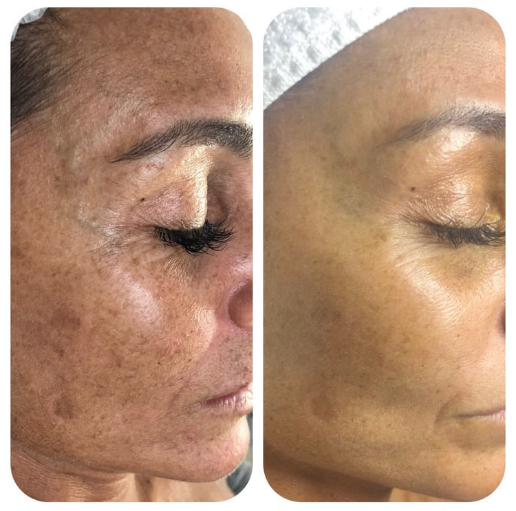 Cure de soins - Microneedling