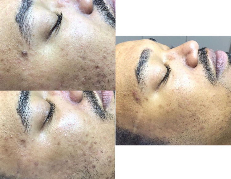 Cure de soins - Microneedling